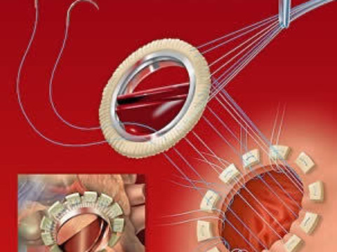 Imaging Assessment of Prosthetic Heart Valves