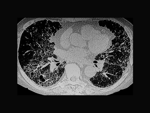 PET/CT Identifies High-Risk Patients in SSc-ILD