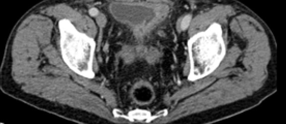 Bladder Cancer Imaging - HealthManagement.org