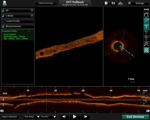 St. Jude Medical Announces European Approval of 3D Vessel Reconstruction Technology St. Jude Medical Announces European Approval of 3D Vessel Reconstruction Technology