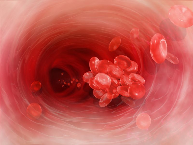 Medications to Prevent Clots not Reaching Some Patients Medications to Prevent Clots not Reaching Some Patients