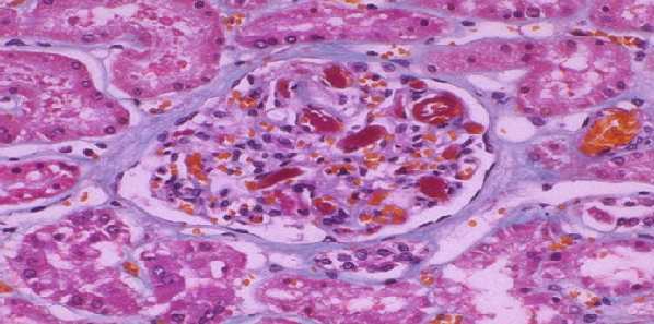 Biomarkers Linked to Kidney Damage, Death in Critically Ill Biomarkers Linked to Kidney Damage, Death in Critically Ill
