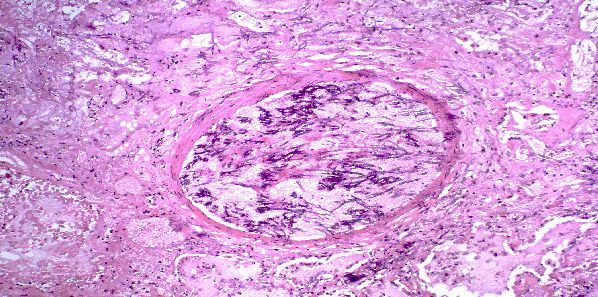 Breath Test for Diagnosing Fungal Pneumonia Breath Test for Diagnosing Fungal Pneumonia