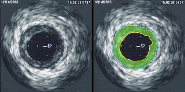 FFR and IVUS-Guided PCI vs Standard PCI FFR and IVUS-Guided PCI vs Standard PCI