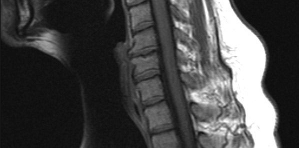 MRI in Cervical Spine Clearance MRI in Cervical Spine Clearance