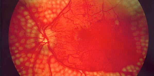 Cardiac Biomarkers Predict Diabetes Complications Cardiac Biomarkers Predict Diabetes Complications
