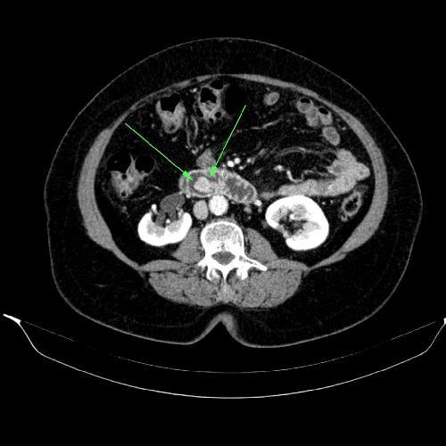 pancreatic-cancer-mri-protocol-for-high-risk-patients