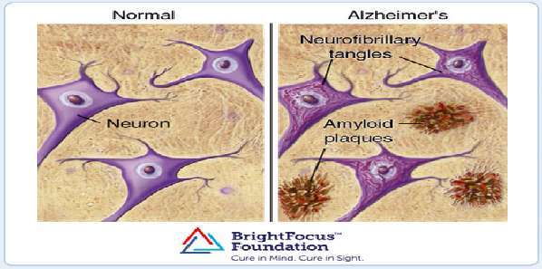 Noninvasive Ultrasound Technology Could Treat Alzheimer’s Disease Noninvasive Ultrasound Technology Could Treat Alzheimer’s Disease