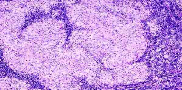 Ultrasound Can ID Breast Cancer Patients Who Need Lymph Nodes Removed Ultrasound Can ID Breast Cancer Patients Who Need Lymph Nodes Removed