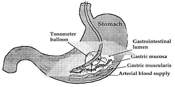 Assessing the Effectiveness of Gastric Tonometry Guided Therapy Assessing the Effectiveness of Gastric Tonometry Guided Therapy