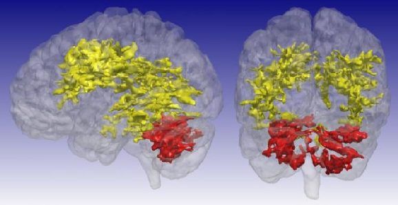 Bipolar Disorder: New MRI Method Provides New Insights Bipolar Disorder: New MRI Method Provides New Insights
