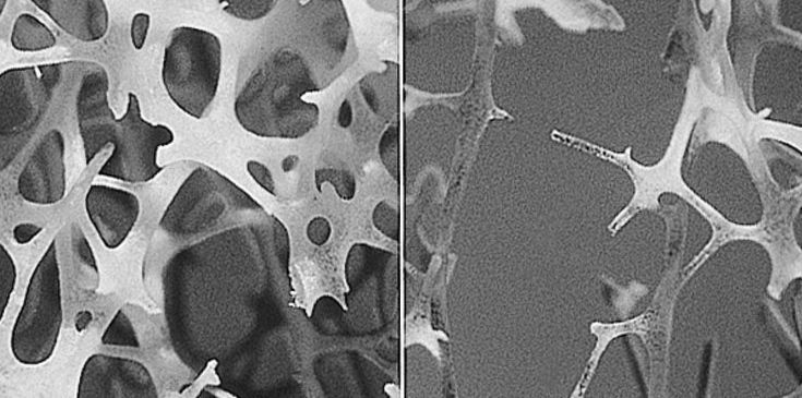 New Tool to Prevent Osteoporotic Fractures New Tool to Prevent Osteoporotic Fractures