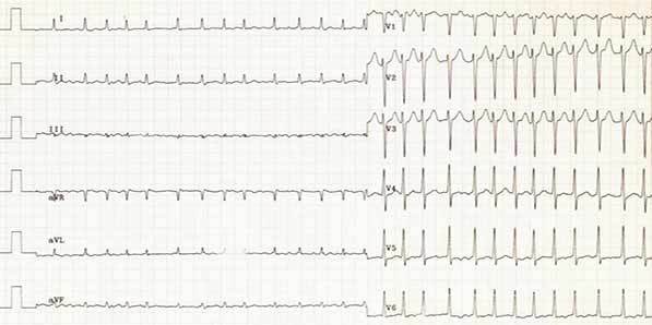P-wave Morphology and Ischemic Stroke P-wave Morphology and Ischemic Stroke