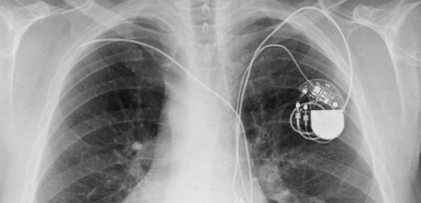 Study: Defibrillator Testing Prior to ICD Procedure Unnecessary Study: Defibrillator Testing Prior to ICD Procedure Unnecessary
