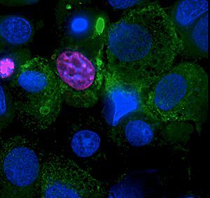 Major Hurdle Cleared to Diabetes Transplants Major Hurdle Cleared to Diabetes Transplants
