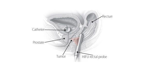 FDA Panel Disapproves Of HIFU For Prostate Cancer FDA Panel Disapproves Of HIFU For Prostate Cancer