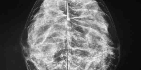 #RSNA14: Role of Adjunct Whole Breast Ultrasound After NY Breast Density Law #RSNA14: Role of Adjunct Whole Breast Ultrasound After NY Breast Density Law