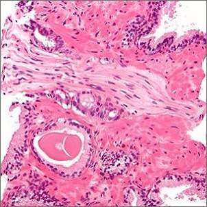 micrograph showing a prostate cancer micrograph showing a prostate cancer