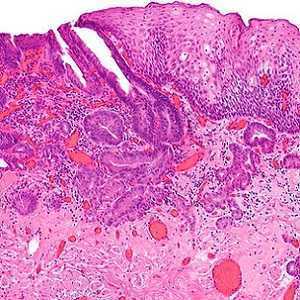 (micrograph) intramucosal oesophageal adenocarcinoma (micrograph) intramucosal oesophageal adenocarcinoma