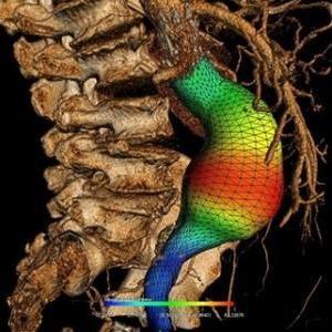 3D reconstruction of an abdominal aortic aneurysm 3D reconstruction of an abdominal aortic aneurysm
