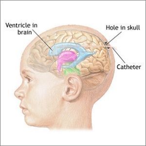 intracranial pressure monitoring (ICP) intracranial pressure monitoring (ICP)