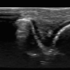 knuckle joint knuckle joint