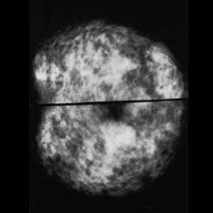 two mammograms of normal dense breasts two mammograms of normal dense breasts