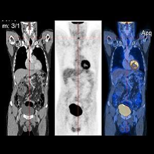 CT image (left), PET image (centre) and overlay of both (right) CT image (left), PET image (centre) and overlay of both (right)