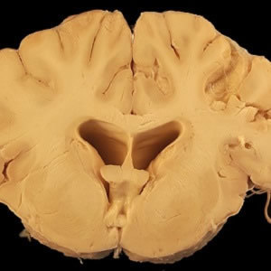 MRI Scans Can Help Spot HIV in the Brain MRI Scans Can Help Spot HIV in the Brain