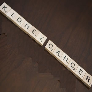 Sestamibi SPECT/CT Scan Improves Kidney Cancer Diagnosis Sestamibi SPECT/CT Scan Improves Kidney Cancer Diagnosis