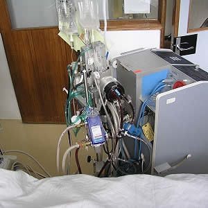 ECMO for Adult Respiratory Failure: 2017 Update ECMO for Adult Respiratory Failure: 2017 Update