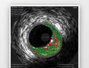 Analysis software / for intravascular ultrasound imaging VH® IVUS Volcano