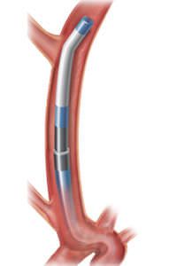 Catheter guidewire Chaperon® MicroVention
