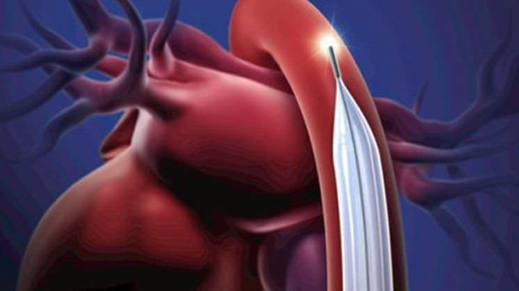 Intra-aortic catheter / balloon SENSATION PLUS® MAQUET