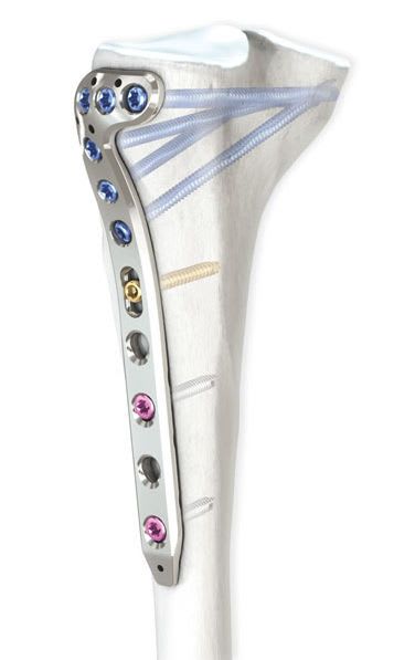 Tibia compression bone plate / proximal / lateral LOQTEQ® Aap Implantate