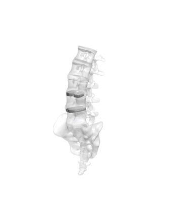 Thoraco-lumbo-sacral interbody fusion cage / posterior MectaLIF - PLIF Medacta