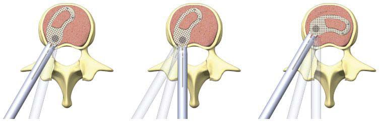 Lumbar interbody fusion cage / transforaminal MectaLIF Transforaminal Medacta