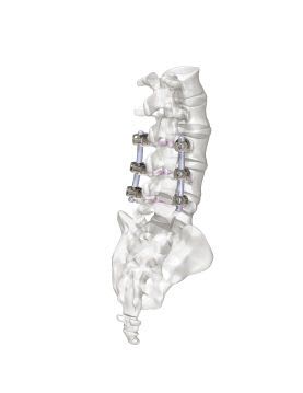 Lumbar spinal osteosynthesis unit / posterior M.U.S.T Medacta