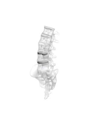 Thoraco-lumbo-sacral interbody fusion cage / posterior MectaLIF - PLIF Medacta