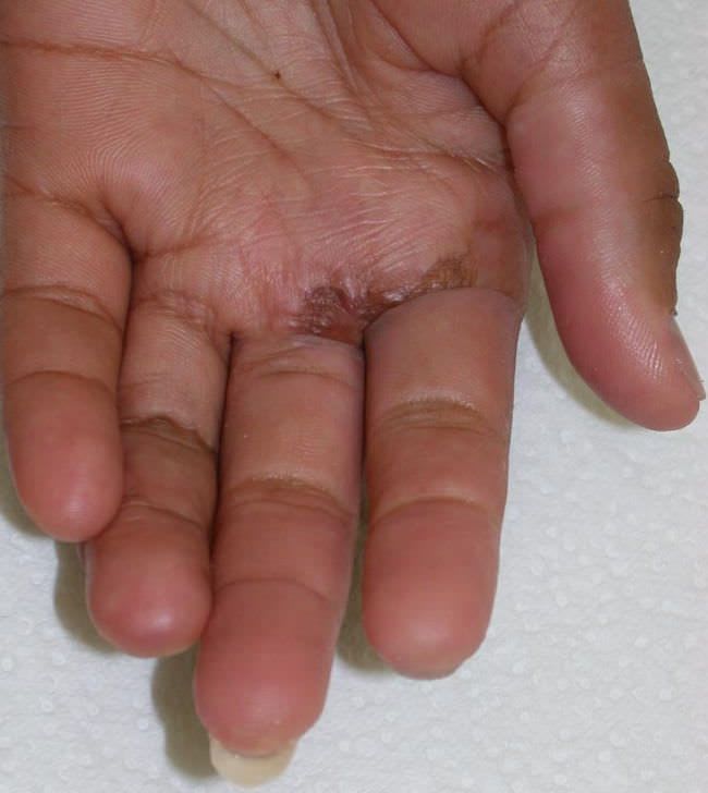 Finger external cosmetic prosthesis Aesthetic Prosthetics
