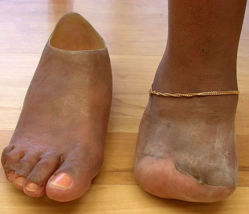Foot external cosmetic prosthesis Aesthetic Prosthetics