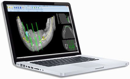 Planning software / 3D viewing / 3D simulation / for implantology Planning 3D Drive Dental Implants