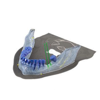 Dental implant simulation software / modeling / 3D viewing / for implantology Reconstruction 3D Drive Dental Implants