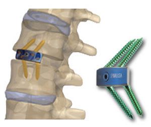 Lumbar interbody fusion cage / anterior AccuFit™ Precision Spine