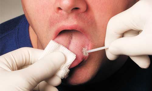 Oral biopsy brush swab OralCDx® CDx Diagnostics