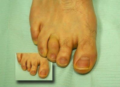 Toe external cosmetic prosthesis The Anaplastology Clinic
