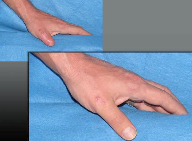 Finger external cosmetic prosthesis Single PHP aesthetic prostheses