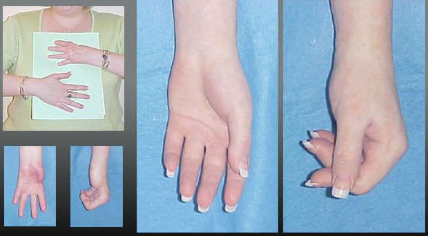 Hand external cosmetic prosthesis Therapeutic PHP aesthetic prostheses