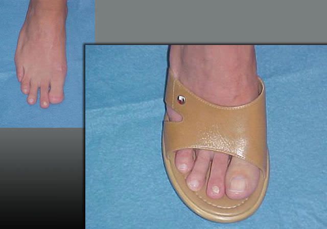 Toe external cosmetic prosthesis PHP aesthetic prostheses