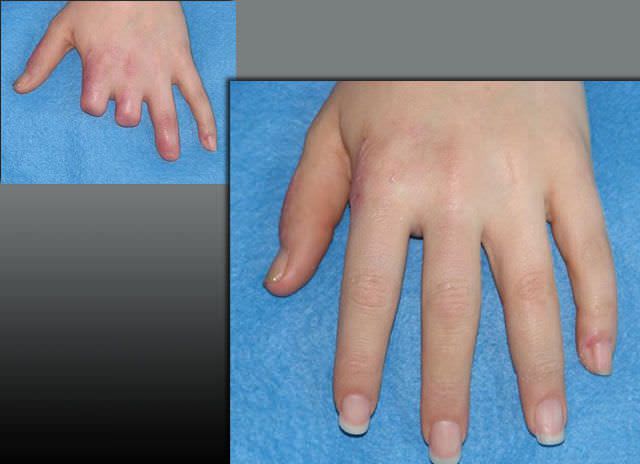 Finger external cosmetic prosthesis PHP aesthetic prostheses